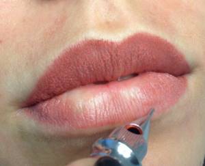 Lip tattoo removal