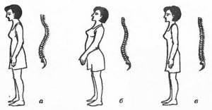 Types of incorrect posture