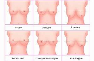 Виды состояний женской груди