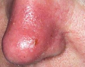Inflamed nose skin due to infection