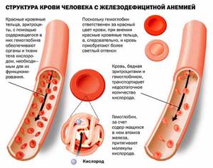 возможные болезни при железодефицитной анемии