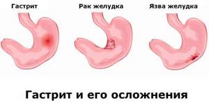 Possible stomach diseases