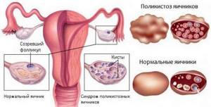Delayed menstruation during menopause: causes and treatment