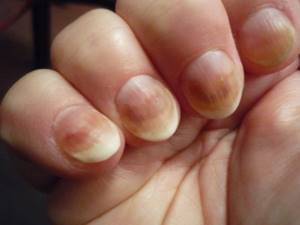 Fungus-infected nails