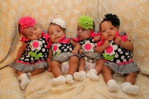 A 42-year-old woman was expecting triplets, but during childbirth the doctor says: More legs