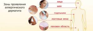 Areas of manifestation of allergic dermatitis